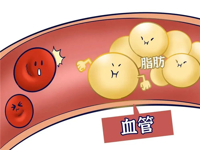 高血脂丨心血管疾病幕後黑手